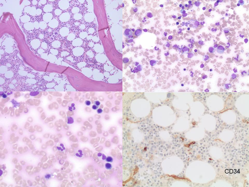 The bone marrow aspirate and biopsy performed two years later shows a marked improvement, with resolution of the erythroid dysplasia and decrease in the blast percentage.